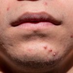 Traiter l'acné chez les jeunes enfants