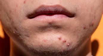 L’acupuncture peut-elle aider avec l’acné de votre adolescent ?